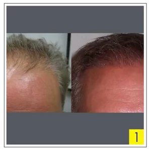 before and after hair transplant