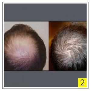 before and after hair transplant
