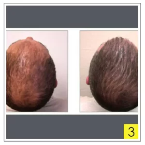 before and after hair transplant