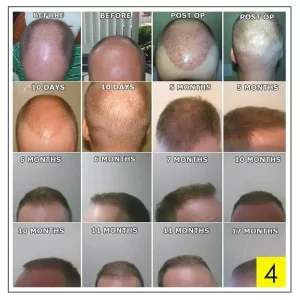 before and after hair transplant